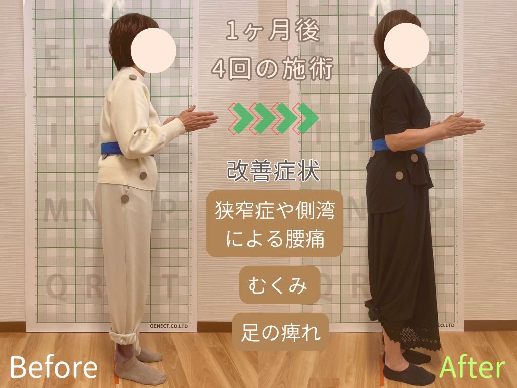 脊柱管狭窄症で腰痛と脚のしびれで悩む女性
