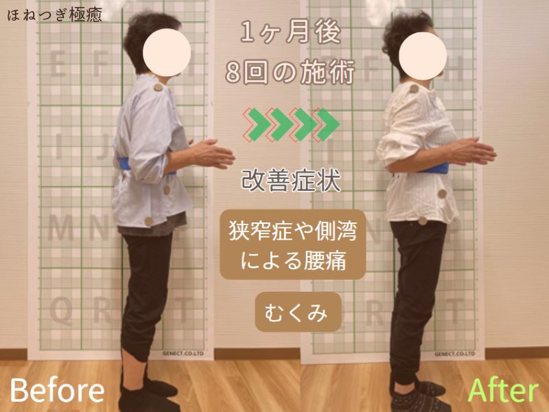 脊柱管狭窄症 Before Afte