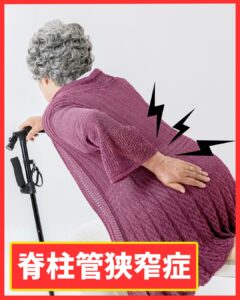 脊柱管狭窄症による腰や足のしびれに悩む中高年の方