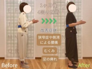 脊柱管狭窄症で腰痛と脚のしびれで悩む女性