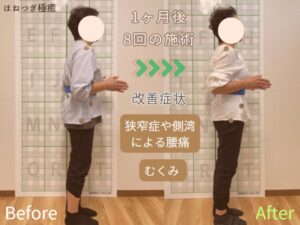 脊柱管狭窄症 Before Afte