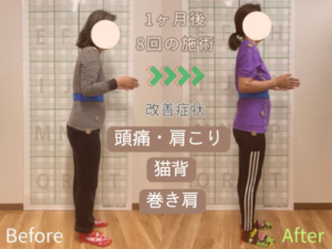 姿勢矯正で頭痛・肩こり・猫背・巻き肩・反り腰が改善