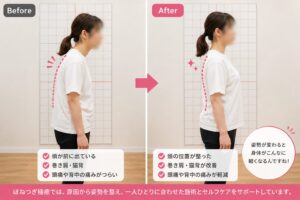 姿勢改善のビフォーアフター比較。30代女性の猫背・巻き肩が改善し、頭痛や背中の痛みが軽減した様子