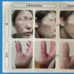 アトピー性皮膚炎の症状が水素によって改善された女性の症例