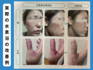 アトピー性皮膚炎の症状が水素によって改善された女性の症例