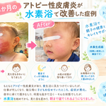 1歳3か月のアトピー性皮膚炎のBefore・Afterと水素浴を紹介する症例画像
