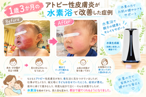 1歳3か月のアトピー性皮膚炎のBefore・Afterと水素浴を紹介する症例画像